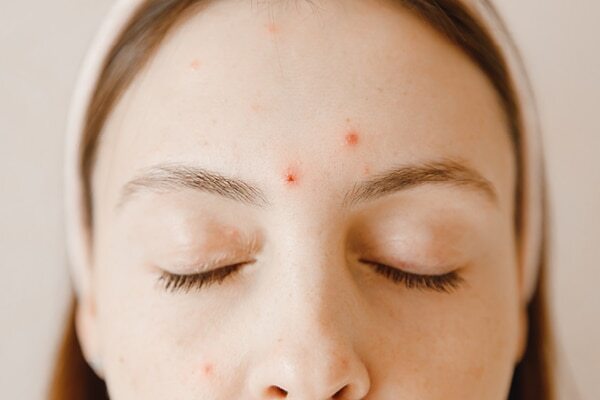 Cold sores - Common types of skin lesions
