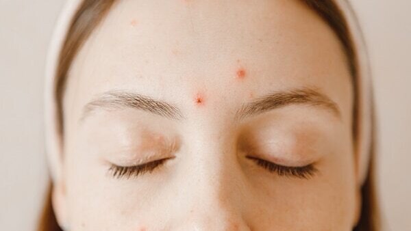 Cold sores - Common types of skin lesions