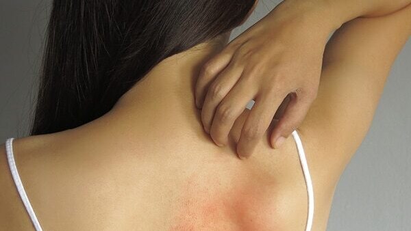 Cold sores - Common types of skin lesions