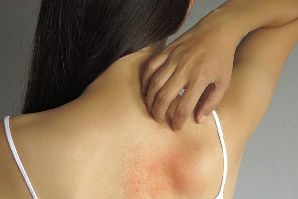 Cold sores - Common types of skin lesions