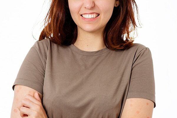Cold sores - Common types of skin lesions