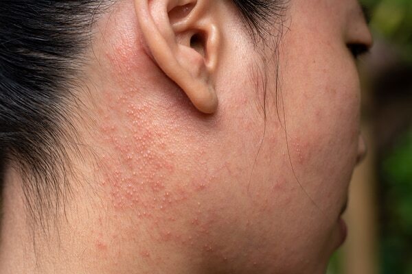 Cold sores - Common types of skin lesions