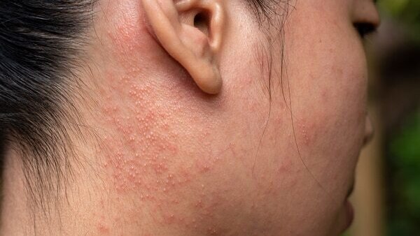 Cold sores - Common types of skin lesions
