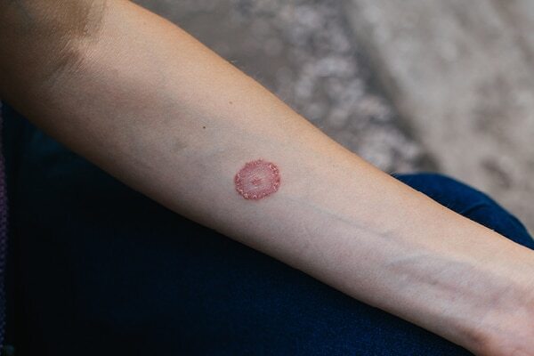 Cold sores - Common types of skin lesions