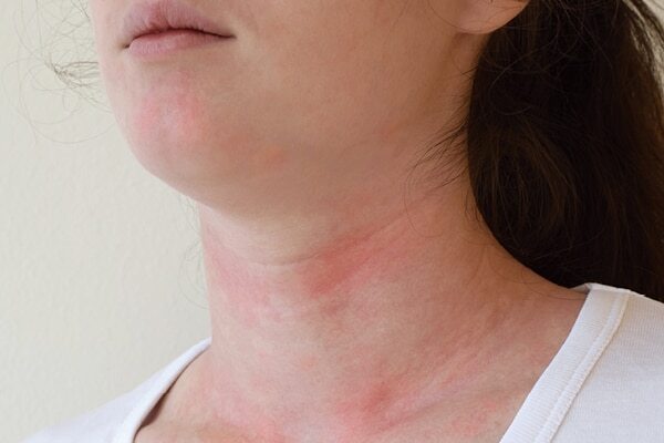 Cold sores - Common types of skin lesions