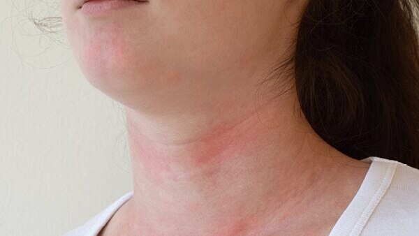 Cold sores - Common types of skin lesions