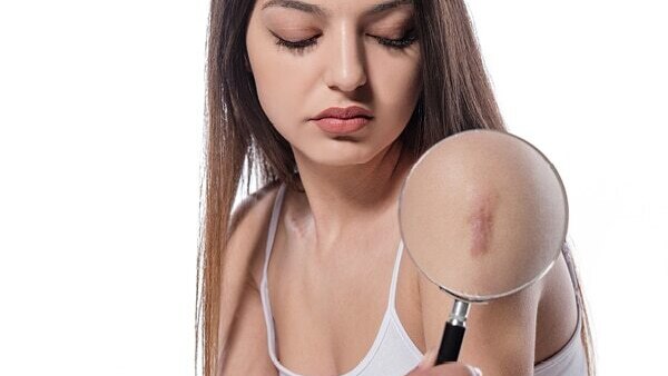 Cold sores - Common types of skin lesions