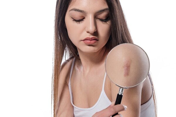 Cold sores - Common types of skin lesions