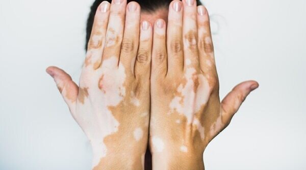 What Is Vitiligo And Best Vitiligo Treatments
