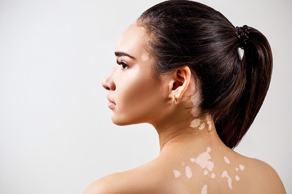 FAQs about vitiligo
