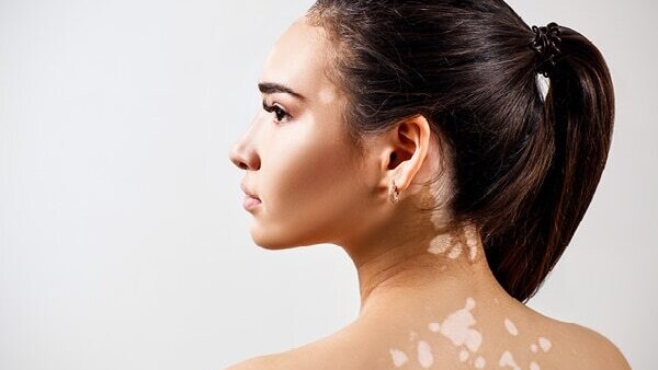 FAQs about vitiligo
