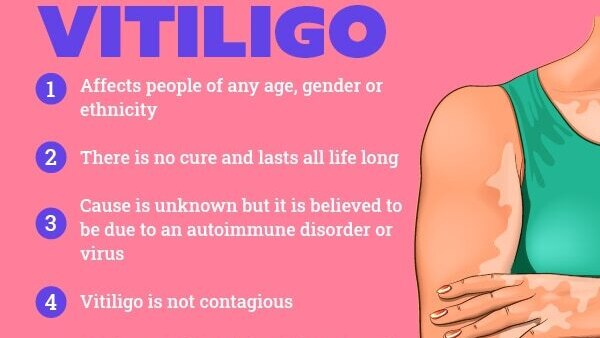 FAQs about vitiligo