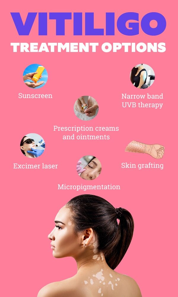 FAQs about vitiligo