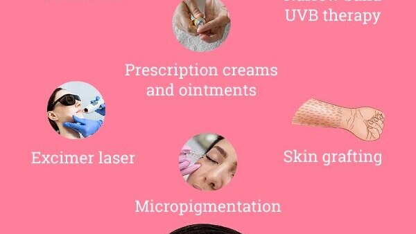 FAQs about vitiligo