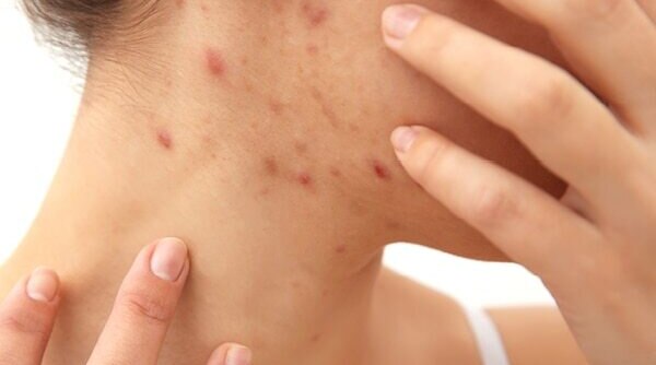 An Expert’s Guide On The Causes, Prevention And Treatment For Scabies