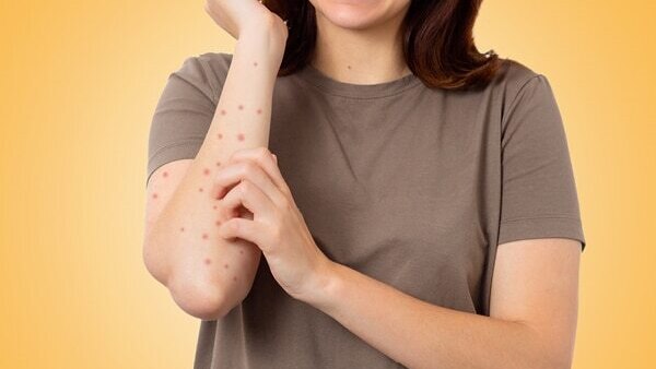 FAQs about scabies