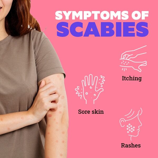 FAQs about scabies
