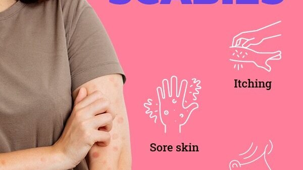 FAQs about scabies