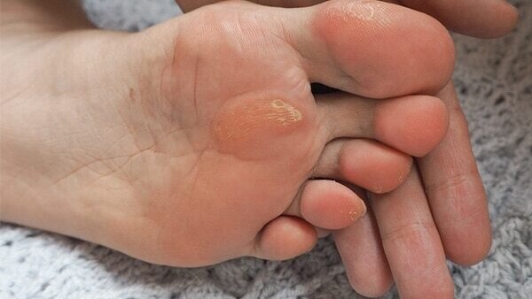 Icy foot soak