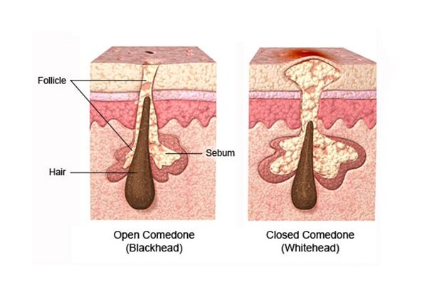 Frequently asked questions about how to remove whiteheads