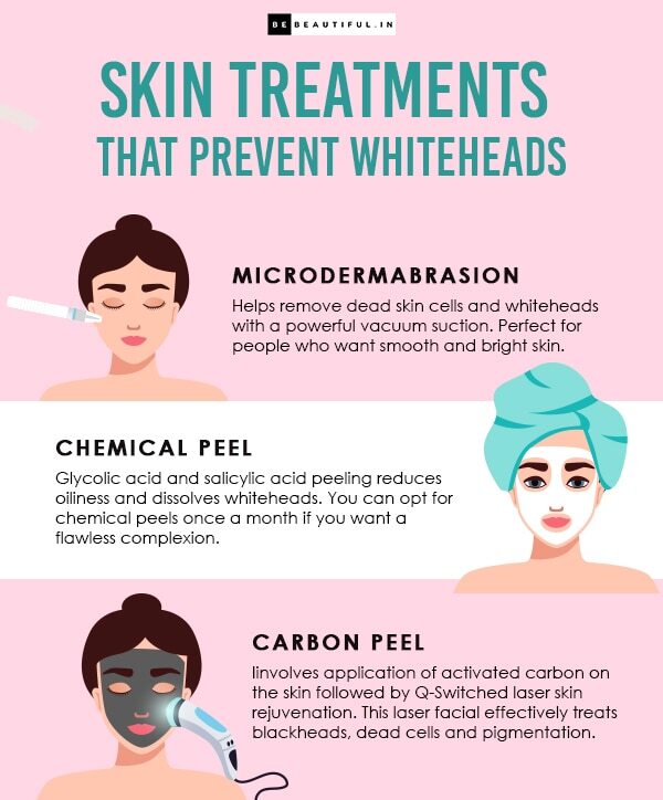 Frequently asked questions about how to remove whiteheads