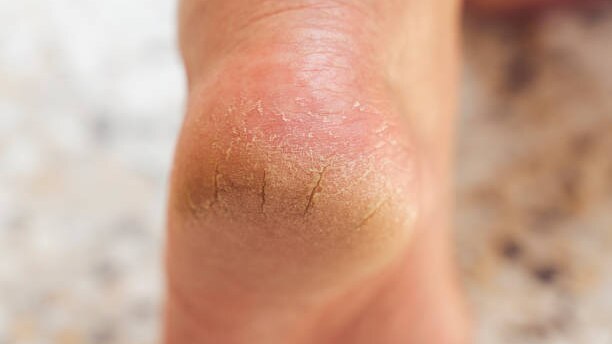 home-remedies-for-cracked-heels