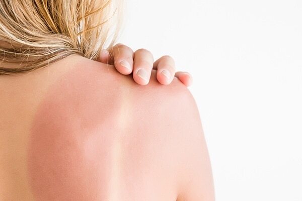 5. Treatment of dandruff