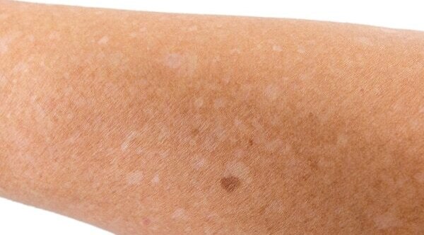 5.	Treatment of dandruff