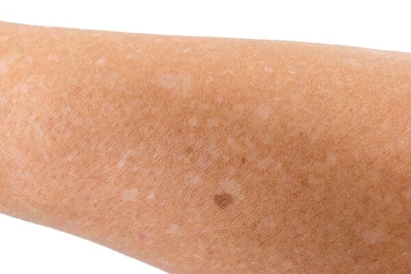 5. Treatment of dandruff
