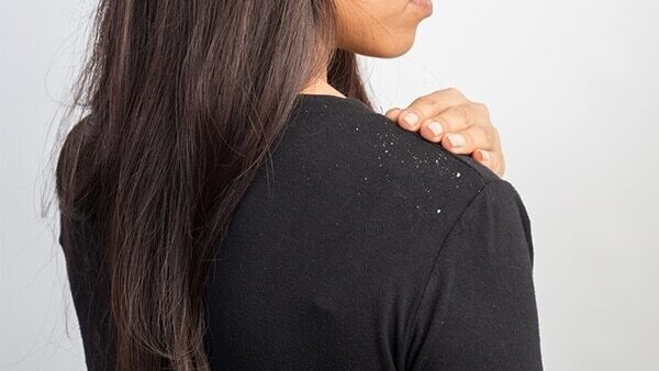 5.	Treatment of dandruff