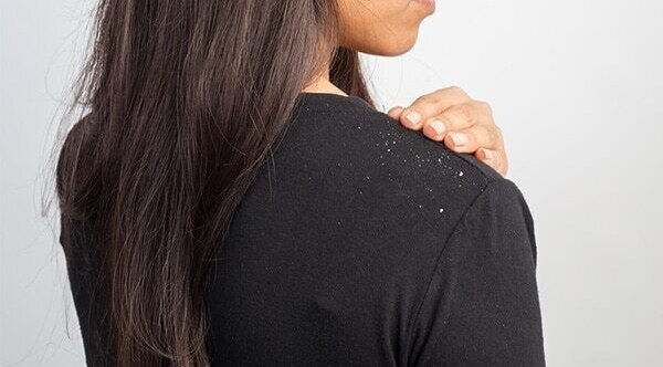 5.	Treatment of dandruff