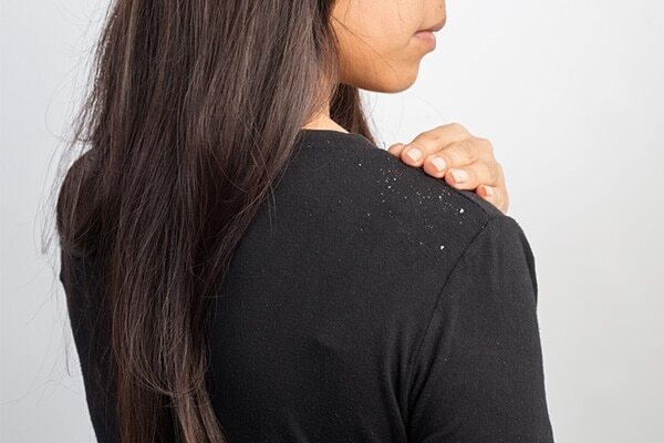 5. Treatment of dandruff
