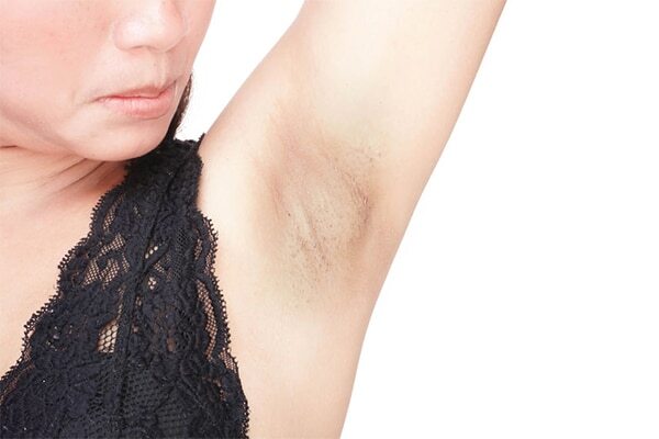 Medical treatments for underarm lightening