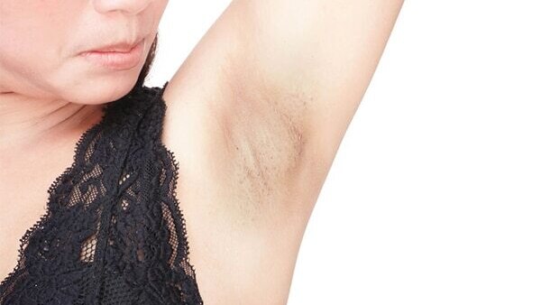 Medical treatments for underarm lightening