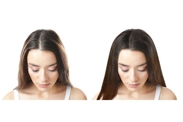 FAQs about minoxidil for women