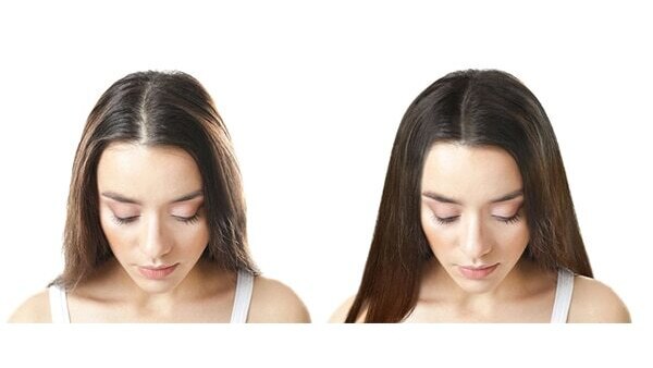FAQs about minoxidil for women