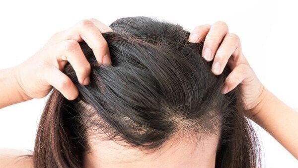 FAQs about minoxidil for women