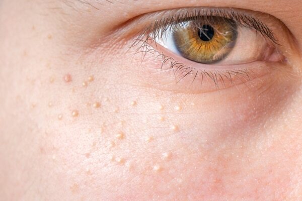 See a dermatologist