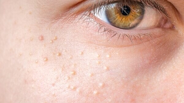 See a dermatologist