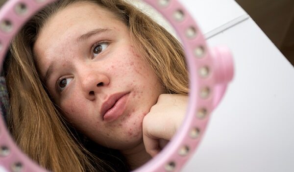 Pesky Pimples Embarrassing You Here's How To Get Rid Of Teenage Pimples Naturally