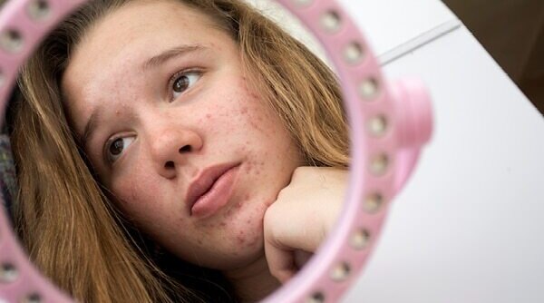 Pesky Pimples Embarrassing You Here's How To Get Rid Of Teenage Pimples Naturally