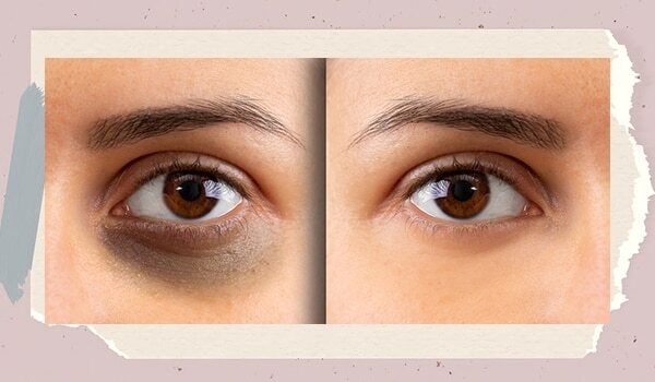 Dark Circles And Puffiness This Is The Expert-Approved Way To Deal With Under-Eye Problems
