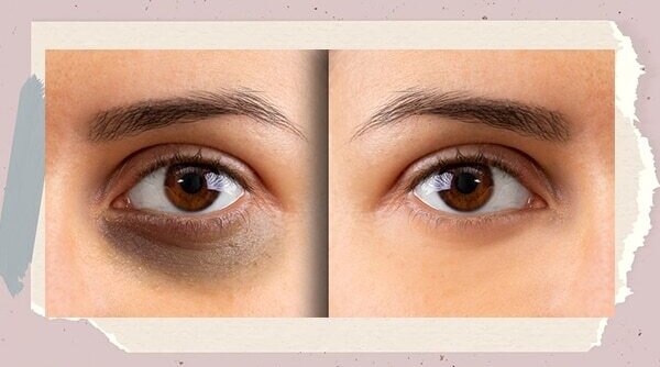 Dark Circles And Puffiness This Is The Expert-Approved Way To Deal With Under-Eye Problems