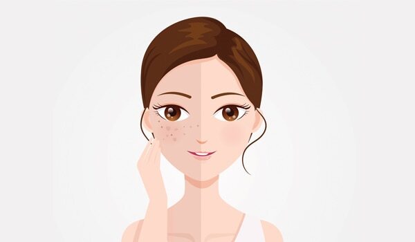 8 Effective Home Remedies For FacePigmentation