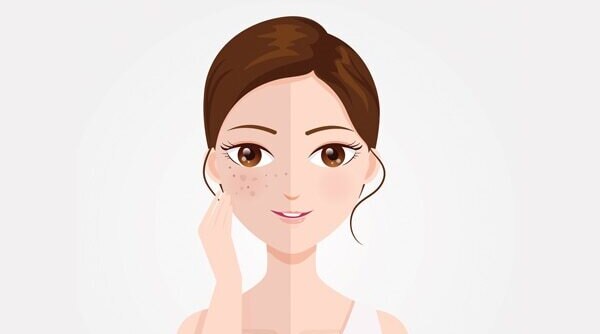 8 Effective Home Remedies For FacePigmentation
