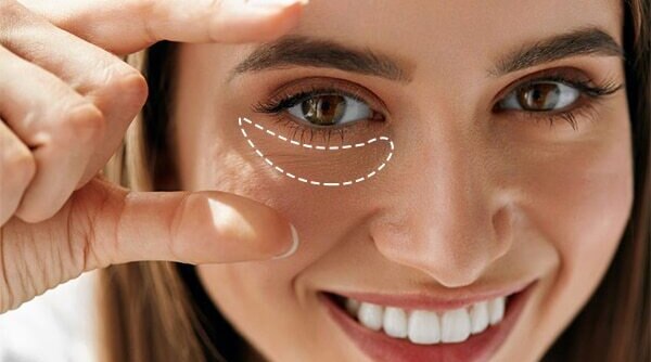 Quick And Effective Ways To Erase Dark Undereye Circles