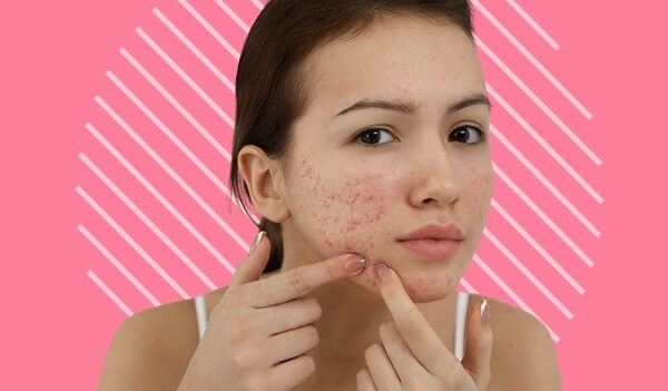 No More Acne Troubles! Best Home Remedies For Cystic Acn