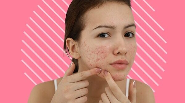No More Acne Troubles! Best Home Remedies For Cystic Acn