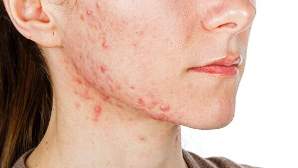 Dermat-Approved Treatments for Cystic Acne