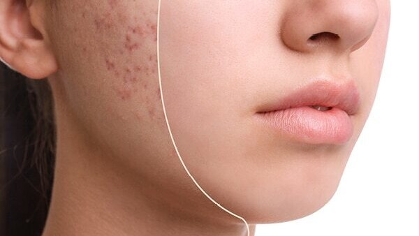 Dermat-Approved Treatments for Cystic Acne